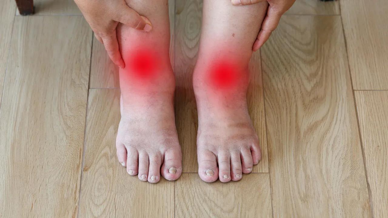 симптоми варикозу